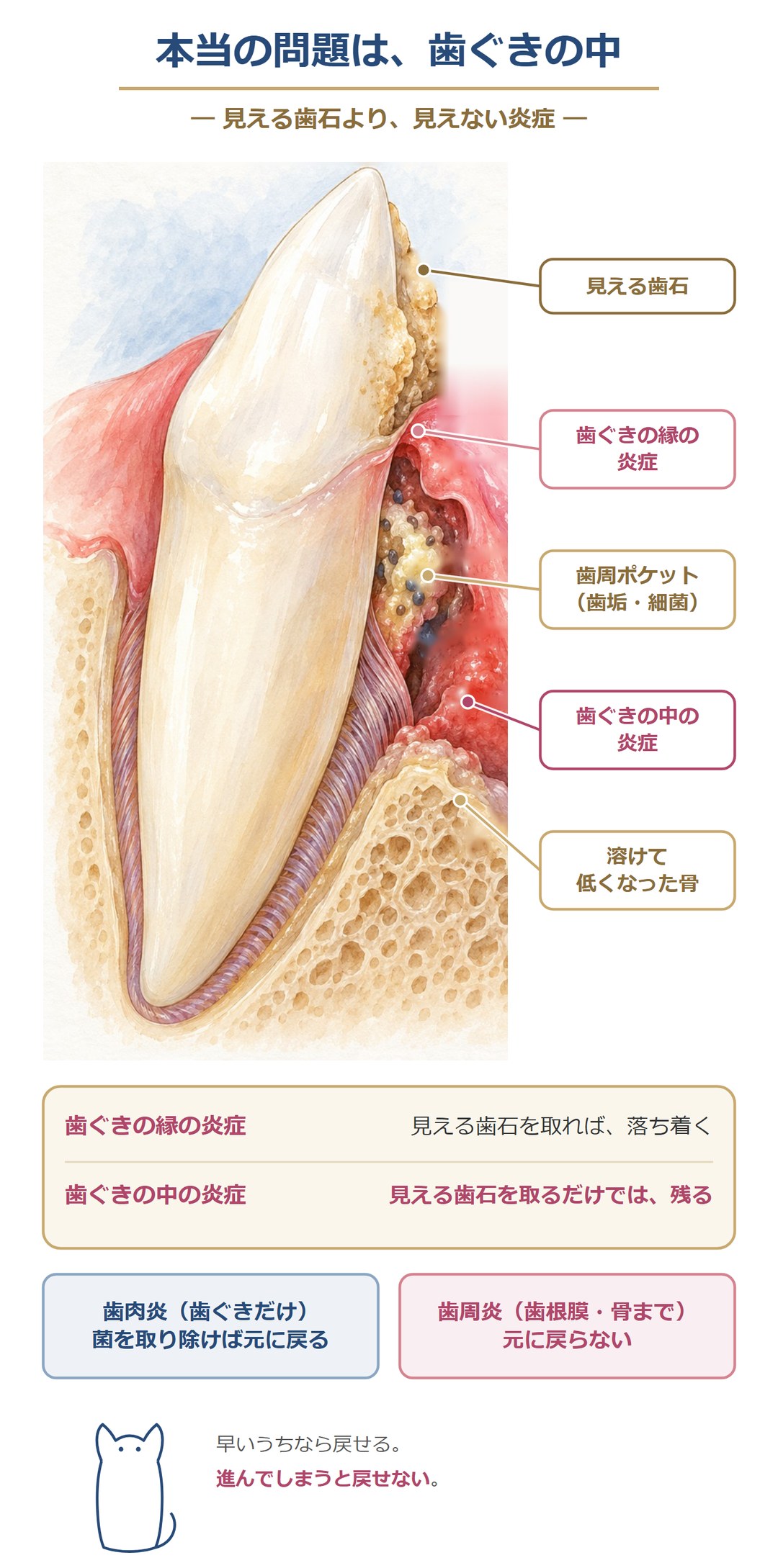 本当の問題は、歯ぐきの中の炎症。歯ぐきの縁の炎症は見える歯石を取れば落ち着くが、歯周ポケットの中の炎症は残り、骨が溶けて低くなる。歯肉炎は元に戻るが、歯周炎は元に戻らない